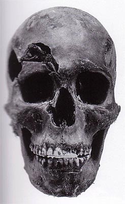 Fig. 18 - Graves lesiones en un cráneo y cara por hacha - (Grupo D)