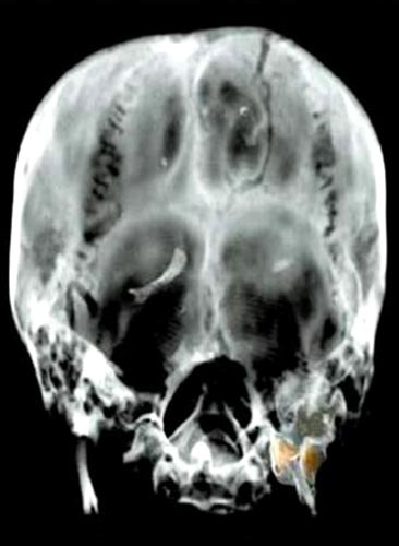 Foto 14 - Cráneo escaneado de Tutankamón